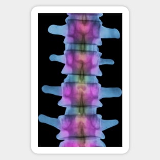 Lumbar spine, X-ray (P116/0393) Sticker